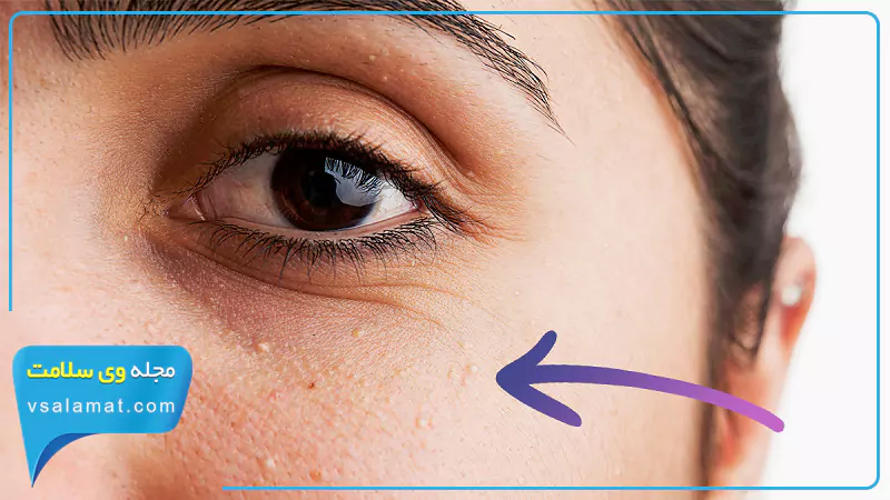 برجستگی کوچک سفید نزدیک چشم از علائم بیماری کبد