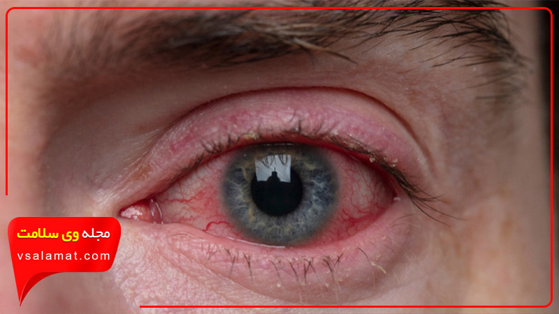 خشکی چشم یکی از علائم سندرم شوگرن است.