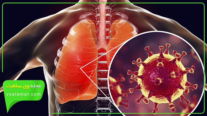 ویروس ها یکی از عوامل ایجاد کننده عفونت ریه هستند.