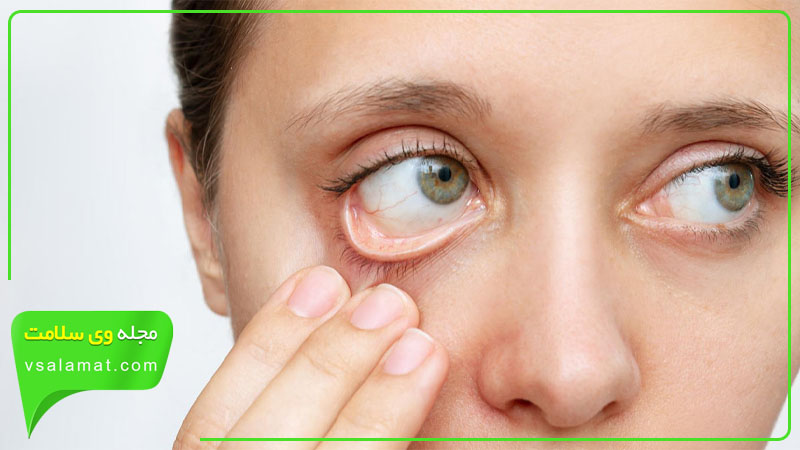 کاهش خشکی چشم یکی دیگر از خواص زردچوبه است.
