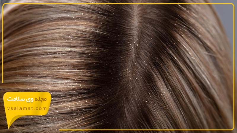 وجود تخم شپش بر روی ساقه مو یکی از علائم شپش سر است.