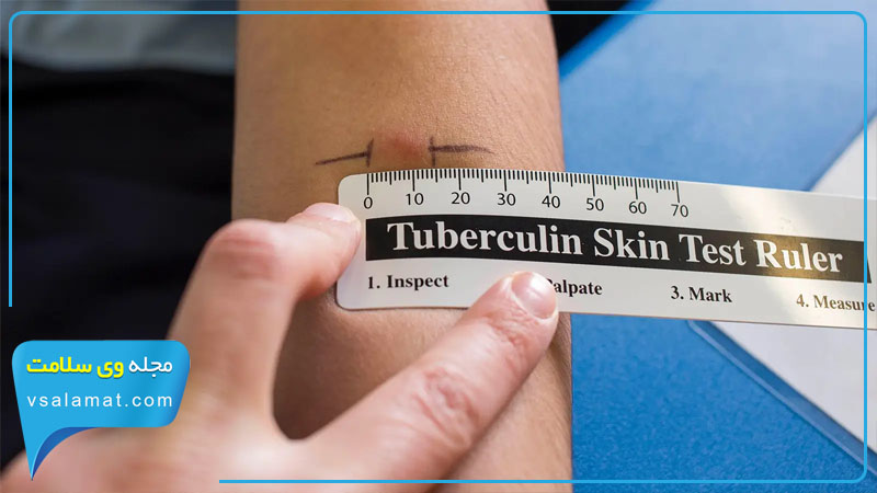 آزمایش پوستی توبرکولین یکی از راه های تشخیص بیماری سل است.