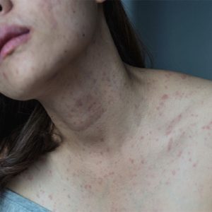انواع آلرژی پوستی