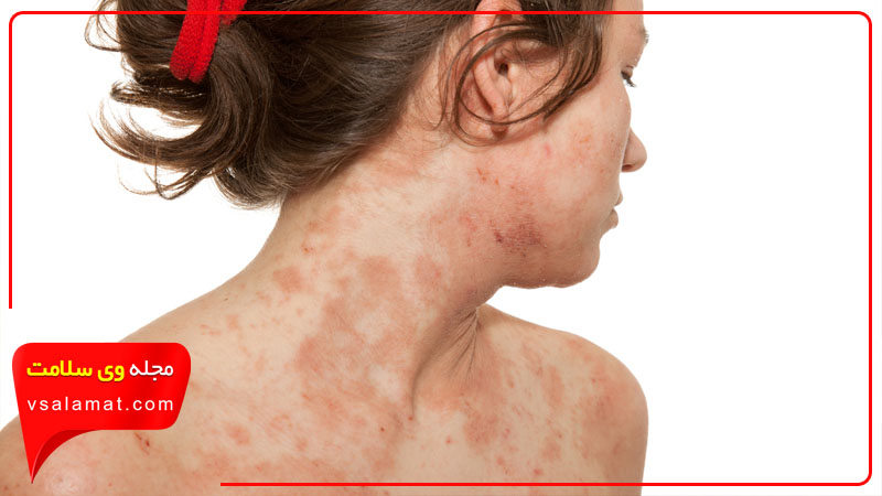 علائم آلرژی پوستی چیست؟