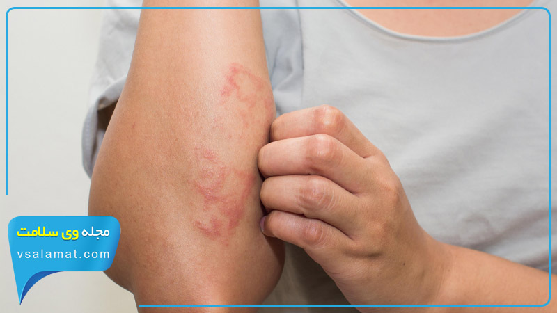 انواع آلرژی پوستی چیست؟