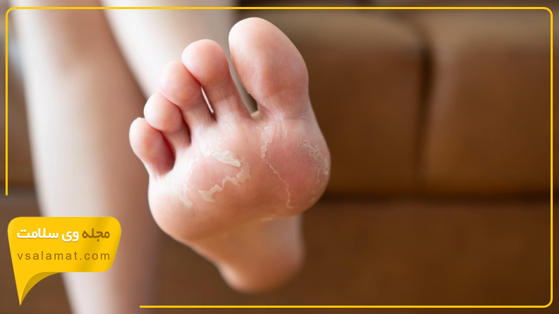 عرق کردن پاها و پوشیدن کفش های بسته منجر به عفونت های قارچی می شود.