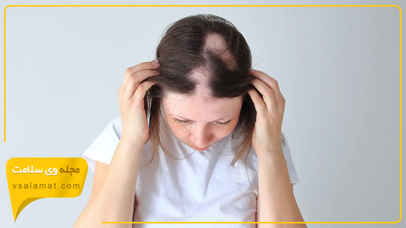 آلوپسی آره آتا یک بیماری خود ایمنی است که باعث ریزش مو می شود.