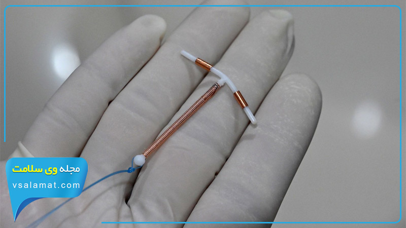 IUD توسط متخصص زنان در داخل رحم قرار داده می شود.
