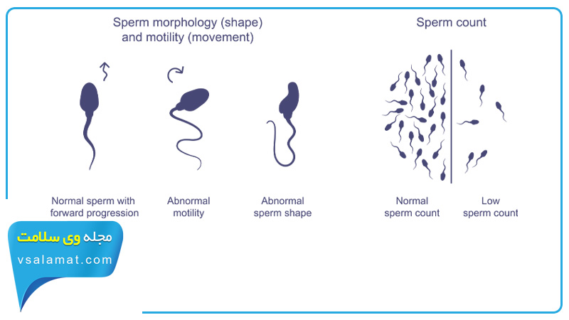 اسپرم سالم با سه معیار تعداد، حرکت و شکل اسپرم سنجیده می شود.